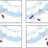 HIDENT – Lo stuzzicadenti sicuro - immagine 4